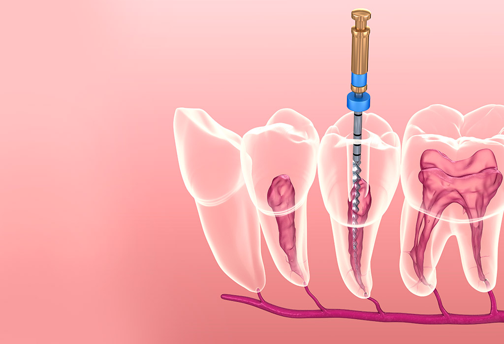 caries i endodòncia a Vilanova del Camí