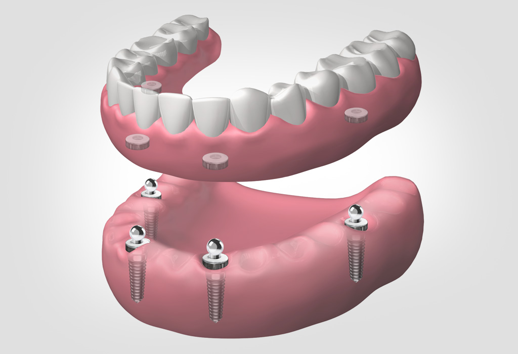 implants dentals a Vilanova del Camí