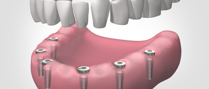 implants dentals a Vilanova del Camí