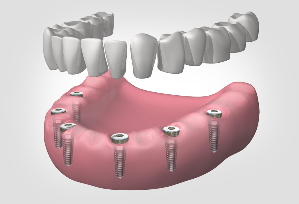 implants dentals a Vilanova del Camí