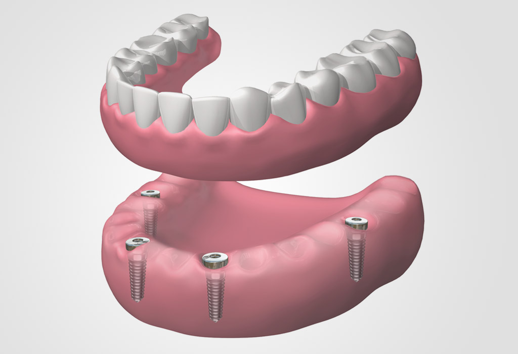 implants dentals a Vilanova del Camí