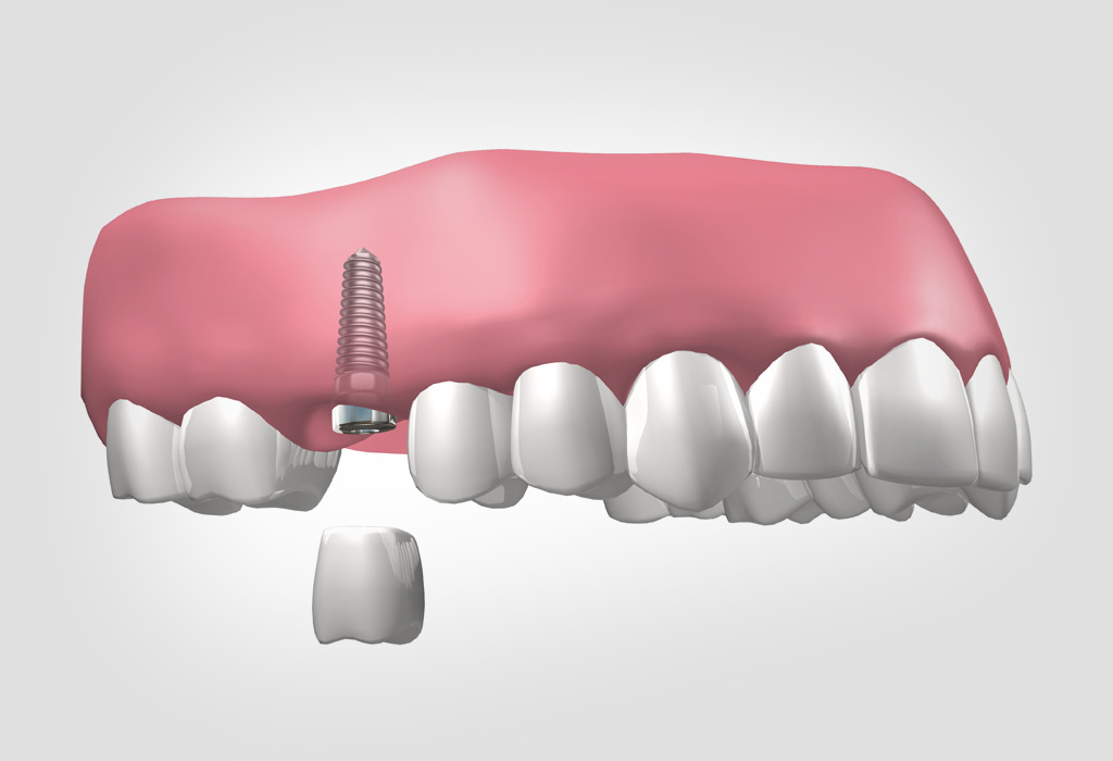 implants dentals a Vilanova del Camí