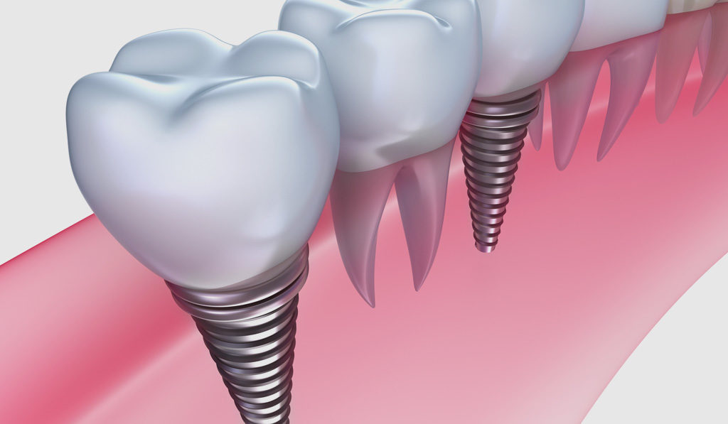 implants dentals a Vilanova del Camí