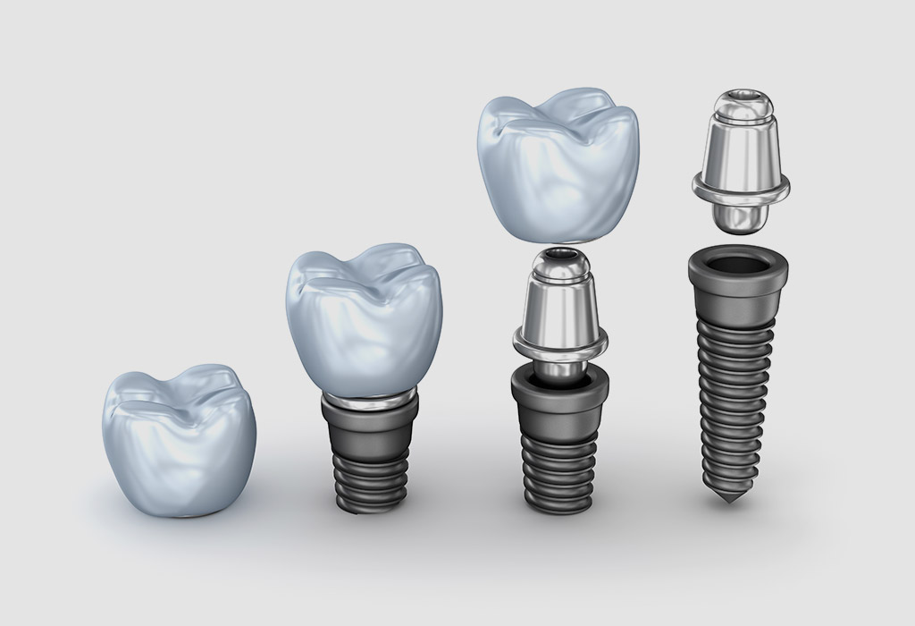 Implantología dental en Vilanova del Camí